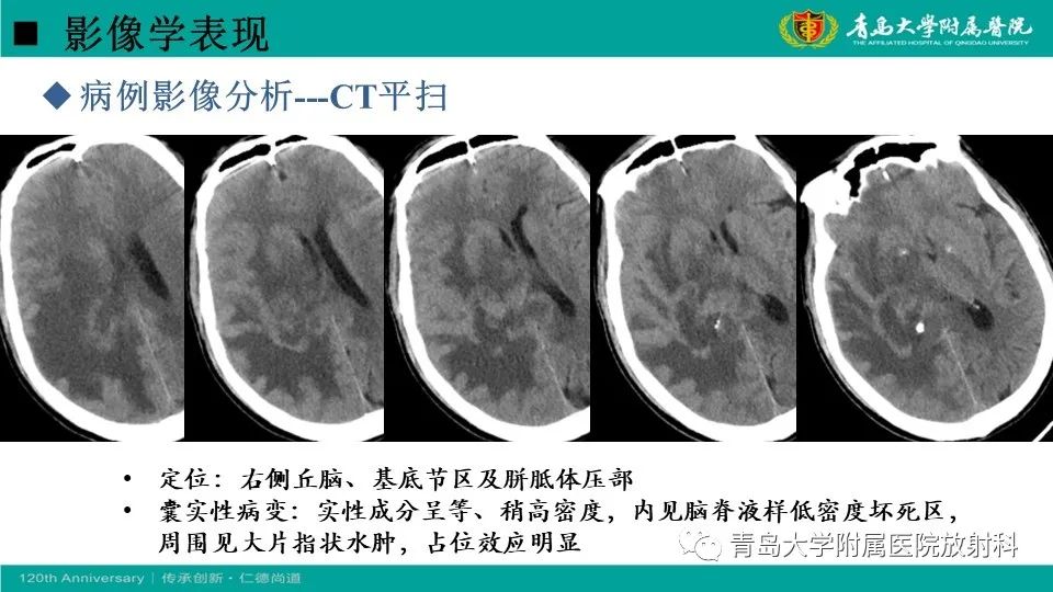 【病例】原发性中枢神经系统淋巴瘤1例CT及MR影像-16