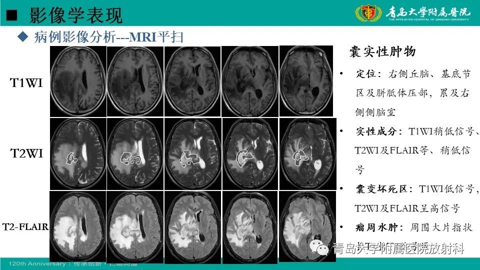 【病例】原发性中枢神经系统淋巴瘤1例CT及MR影像-17
