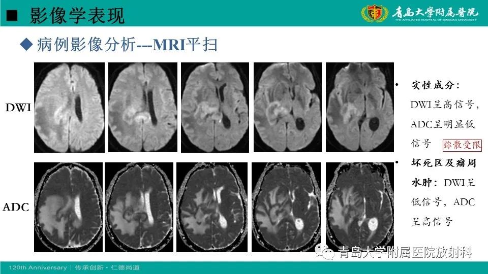 【病例】原发性中枢神经系统淋巴瘤1例CT及MR影像-18