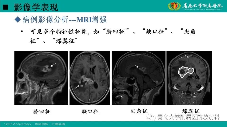 【病例】原发性中枢神经系统淋巴瘤1例CT及MR影像-20