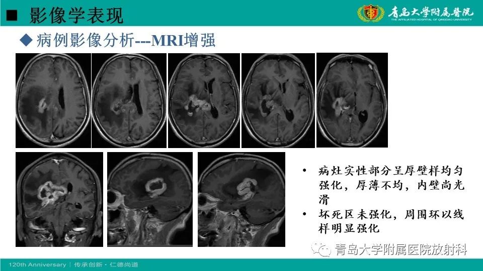 【病例】原发性中枢神经系统淋巴瘤1例CT及MR影像-19