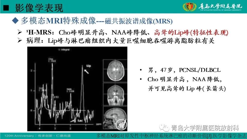【病例】原发性中枢神经系统淋巴瘤1例CT及MR影像-23