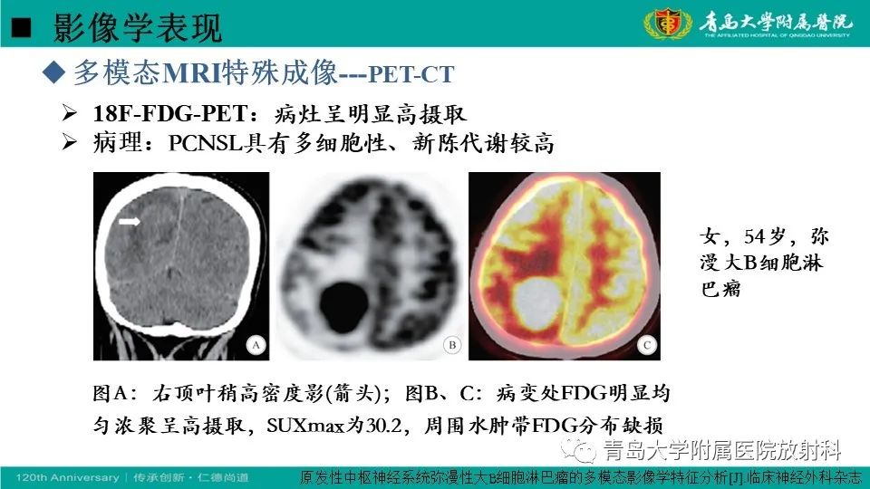 【病例】原发性中枢神经系统淋巴瘤1例CT及MR影像-24