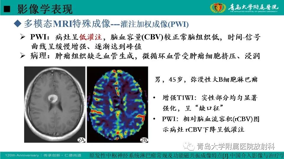 【病例】原发性中枢神经系统淋巴瘤1例CT及MR影像-22