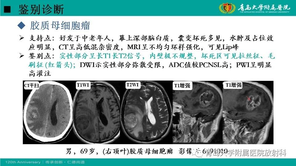 【病例】原发性中枢神经系统淋巴瘤1例CT及MR影像-26