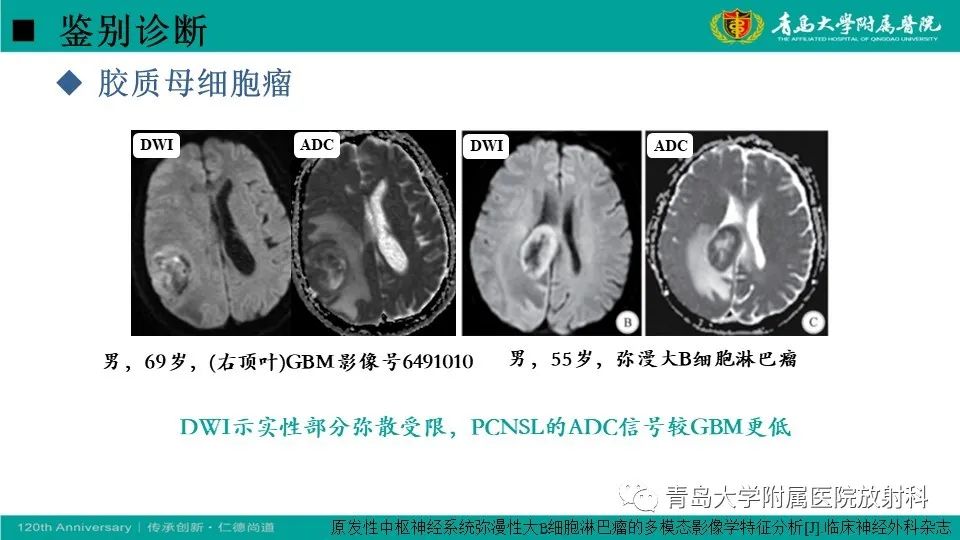 【病例】原发性中枢神经系统淋巴瘤1例CT及MR影像-27