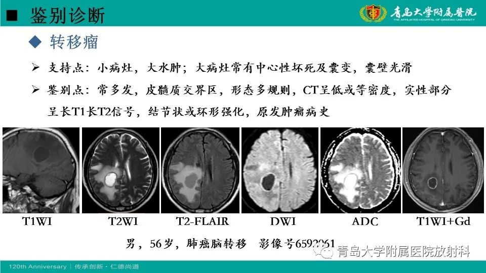 【病例】原发性中枢神经系统淋巴瘤1例CT及MR影像-29