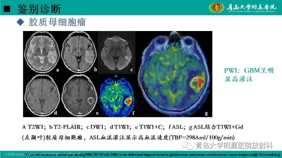 【病例】原发性中枢神经系统淋巴瘤1例CT及MR影像-28