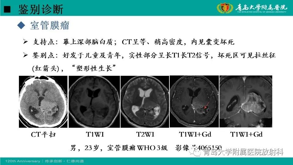 【病例】原发性中枢神经系统淋巴瘤1例CT及MR影像-30