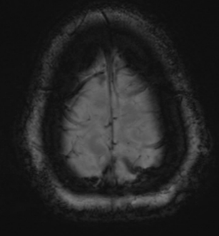 【病例】静脉血栓形成伴梗死/出血2例CT及MR-35