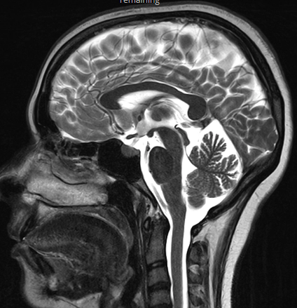 【病例】静脉血栓形成伴梗死/出血2例CT及MR-36