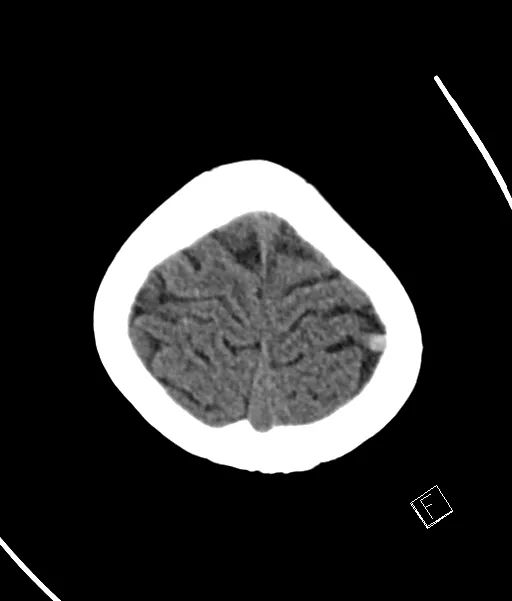 【病例】静脉血栓形成伴梗死/出血2例CT及MR-50