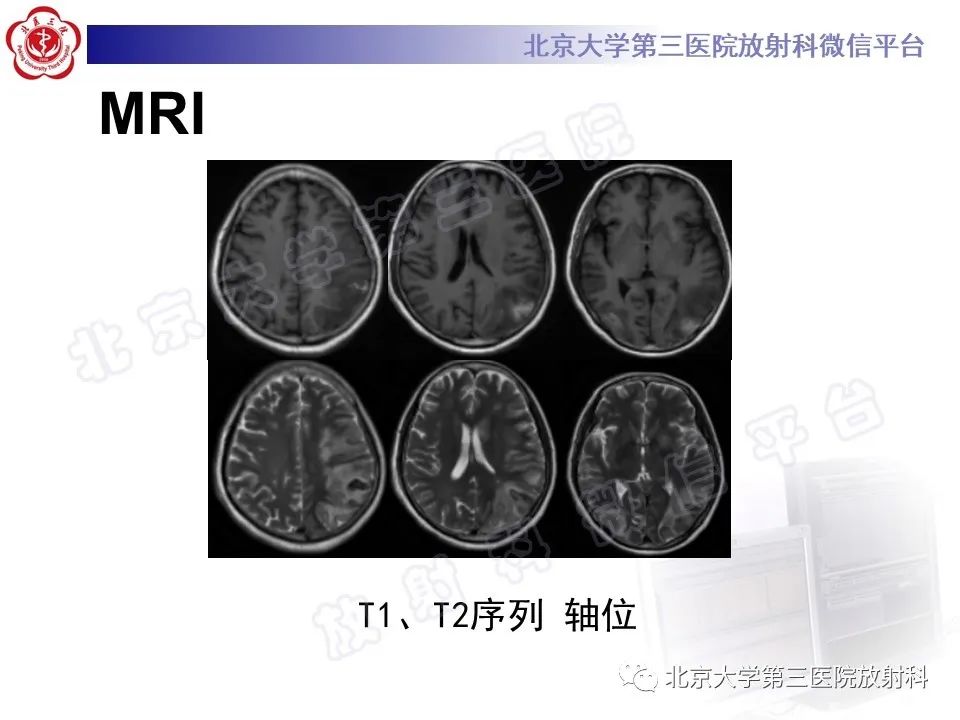 【PPT】脑膜转移瘤-4