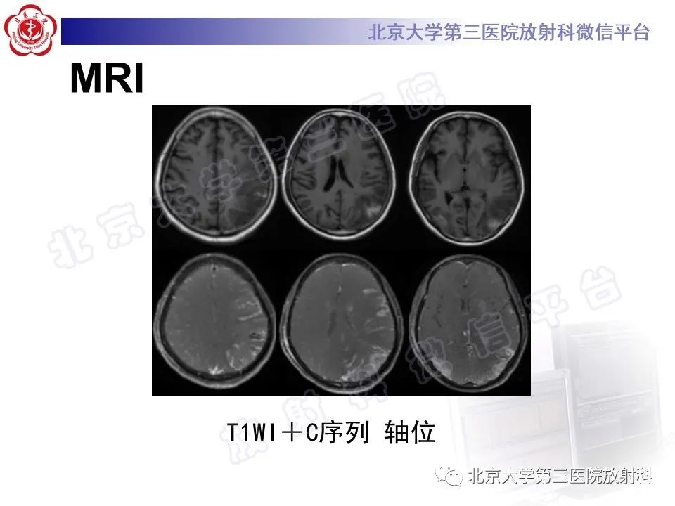 【PPT】脑膜转移瘤-5