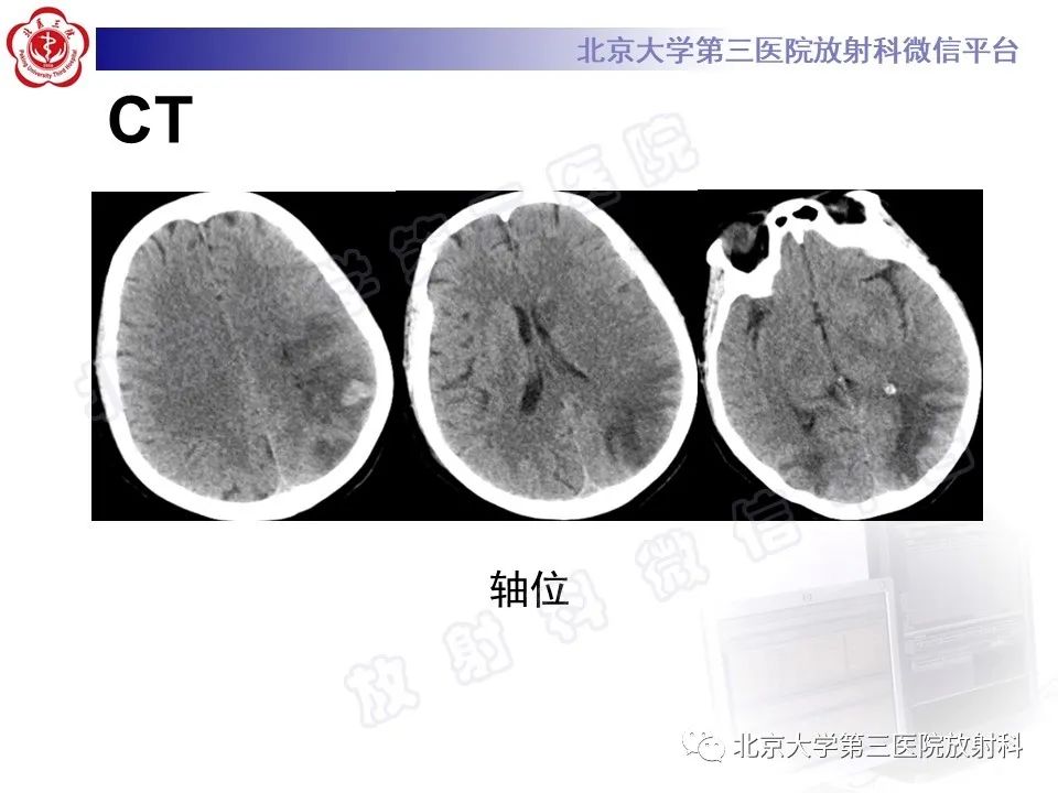 【PPT】脑膜转移瘤-3