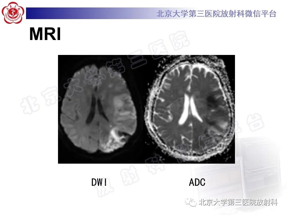 【PPT】脑膜转移瘤-6