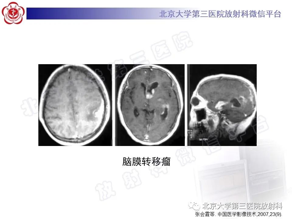 【PPT】脑膜转移瘤-17