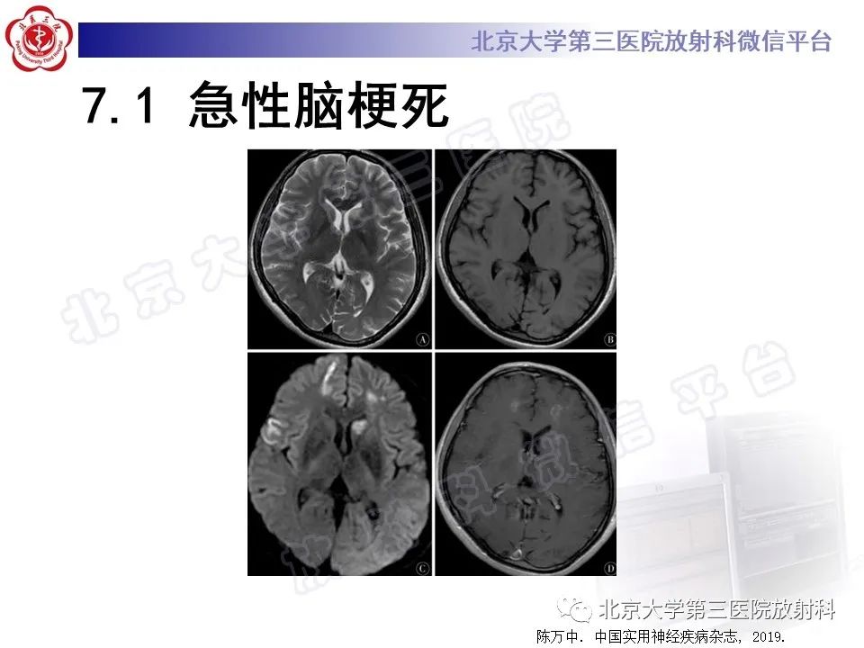 【PPT】脑膜转移瘤-22