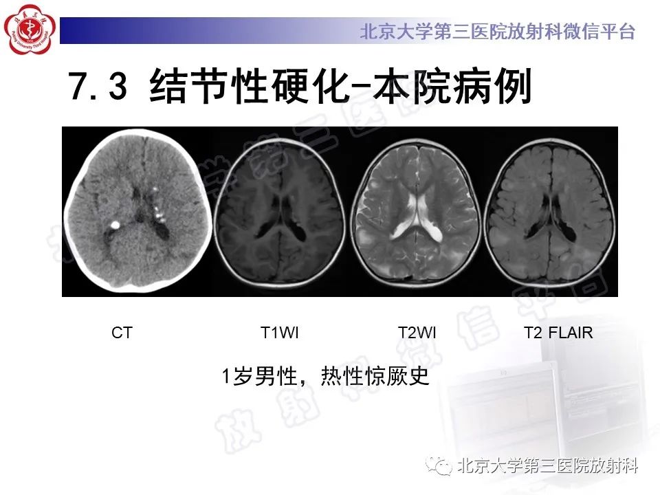 【PPT】脑膜转移瘤-29