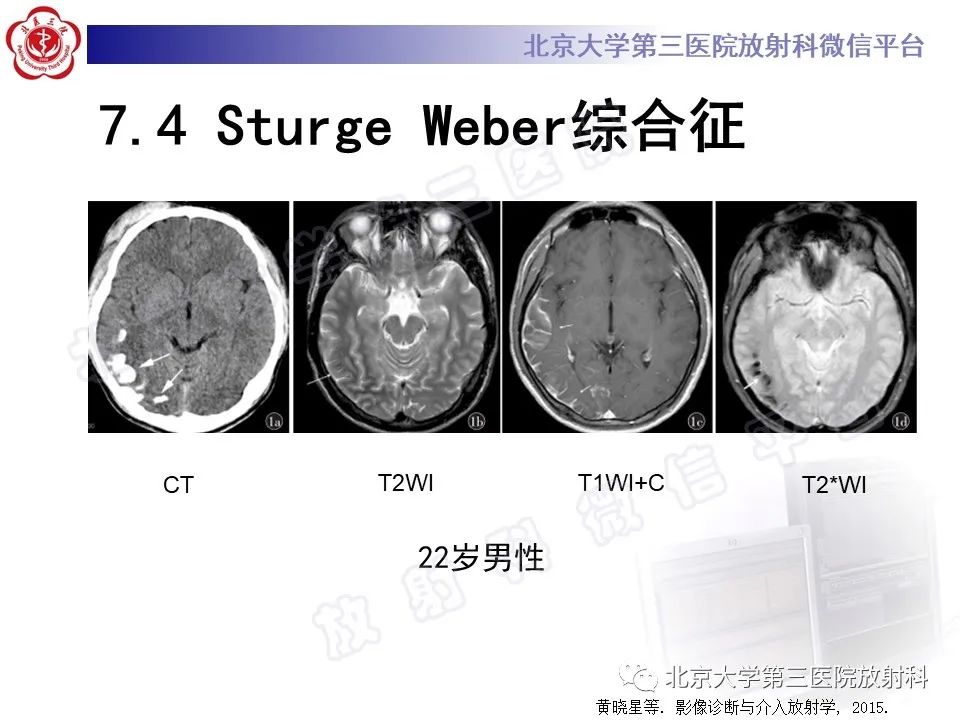 【PPT】脑膜转移瘤-32