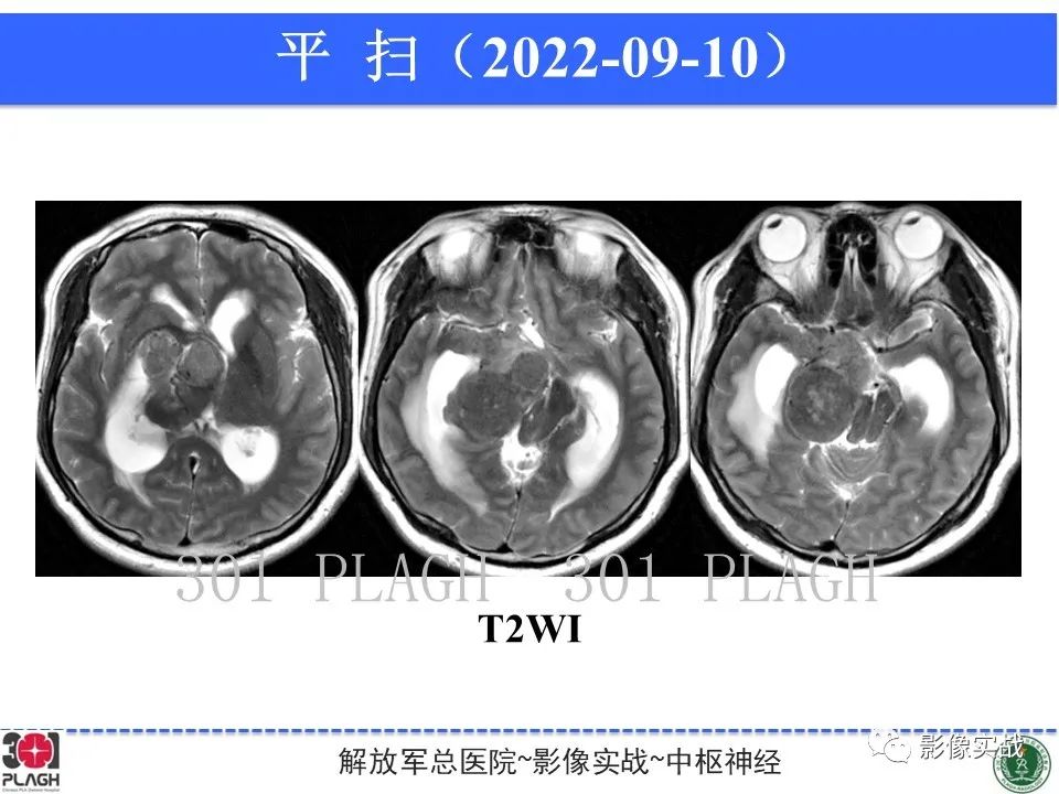 【病例】鞍区孤立性纤维瘤1例CT及MR影像-5