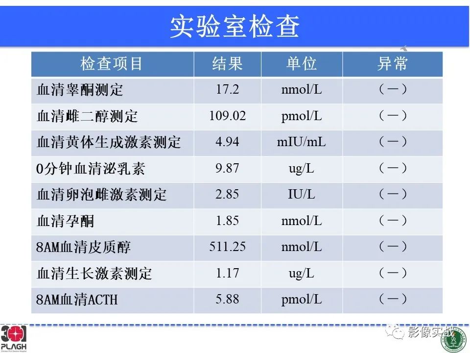 【病例】鞍区孤立性纤维瘤1例CT及MR影像-4