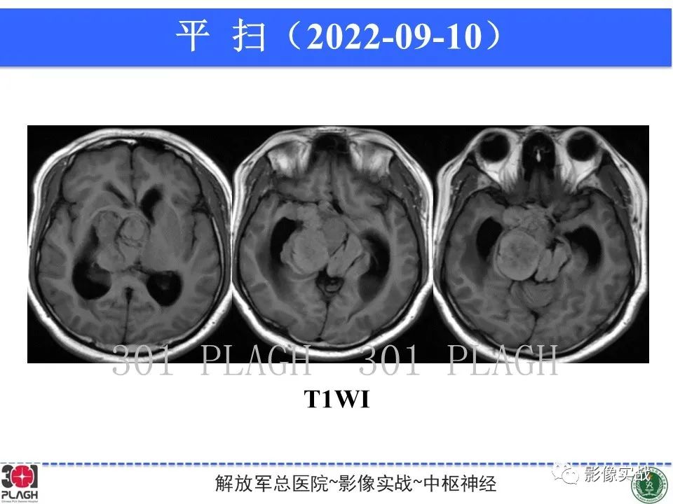 【病例】鞍区孤立性纤维瘤1例CT及MR影像-6