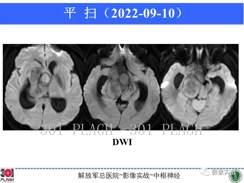 【病例】鞍区孤立性纤维瘤1例CT及MR影像-7