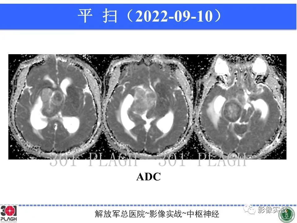 【病例】鞍区孤立性纤维瘤1例CT及MR影像-8