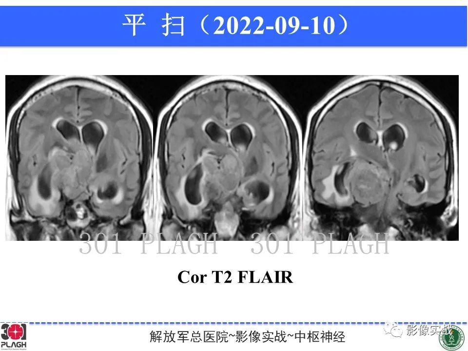 【病例】鞍区孤立性纤维瘤1例CT及MR影像-9