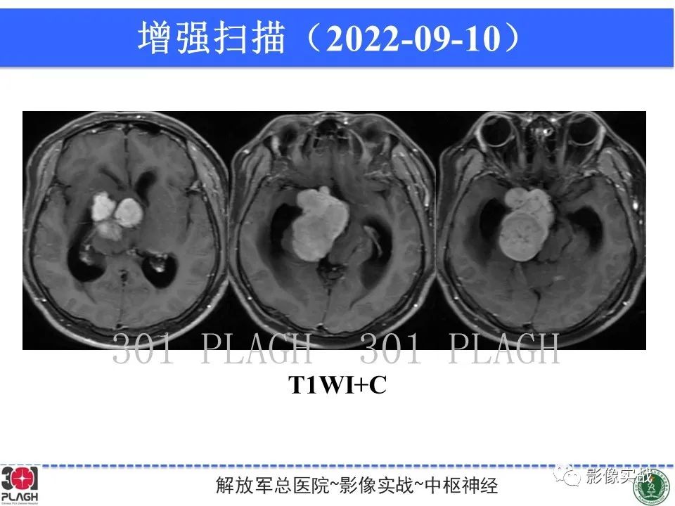 【病例】鞍区孤立性纤维瘤1例CT及MR影像-10