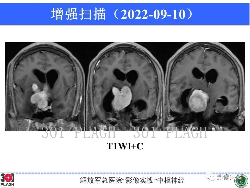 【病例】鞍区孤立性纤维瘤1例CT及MR影像-11