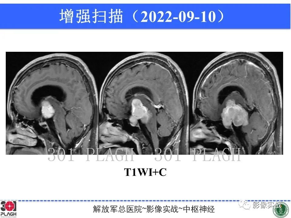 【病例】鞍区孤立性纤维瘤1例CT及MR影像-12