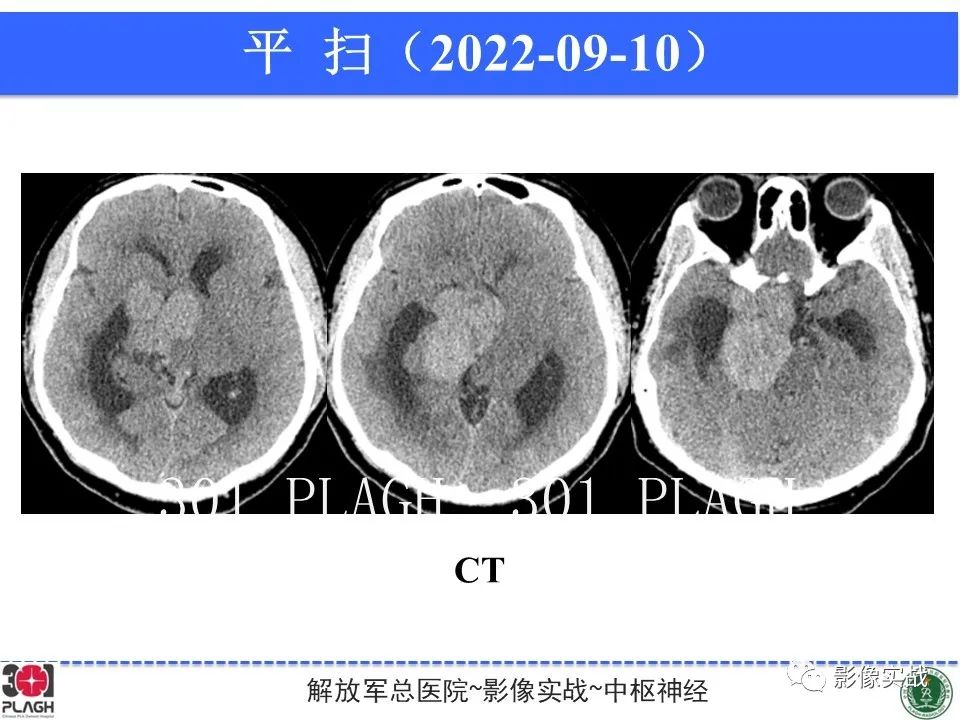 【病例】鞍区孤立性纤维瘤1例CT及MR影像-13