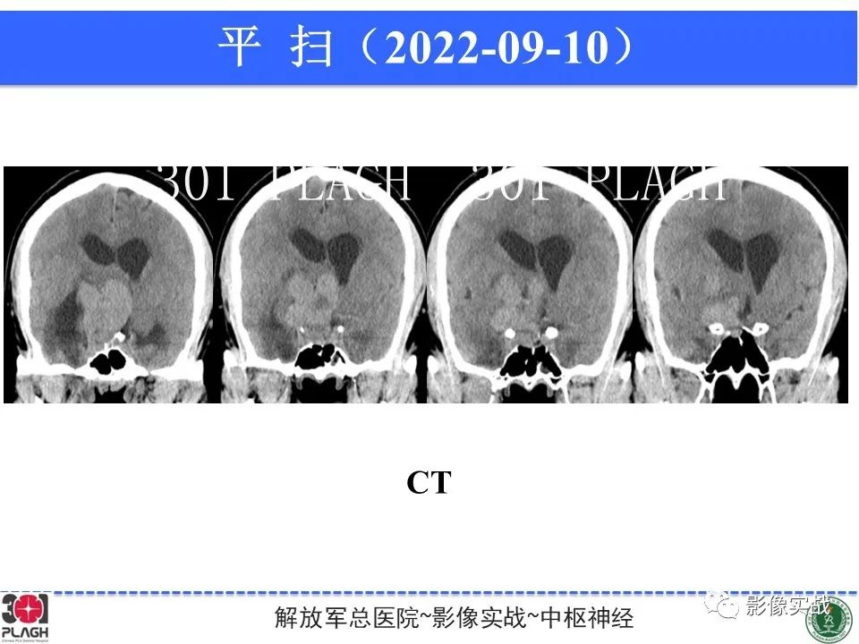 【病例】鞍区孤立性纤维瘤1例CT及MR影像-14