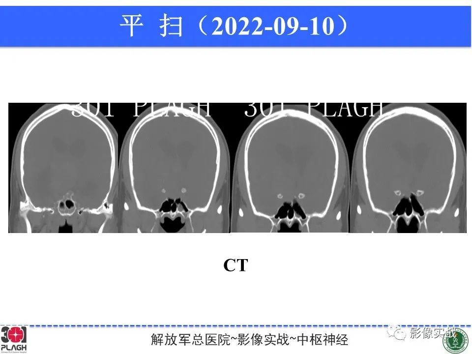 【病例】鞍区孤立性纤维瘤1例CT及MR影像-15
