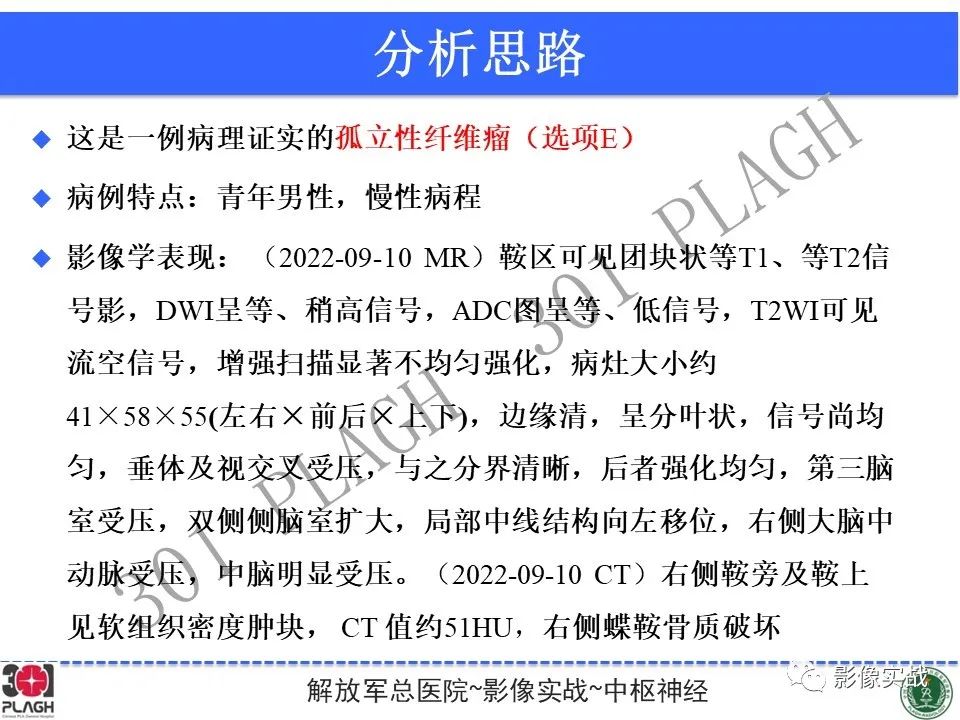 【病例】鞍区孤立性纤维瘤1例CT及MR影像-17