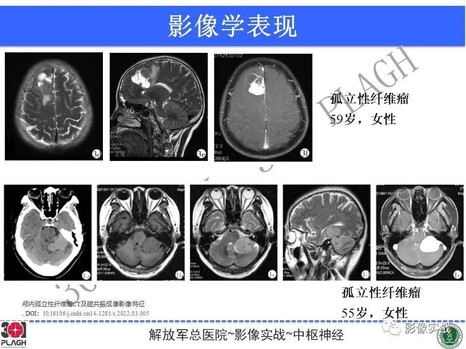 【病例】鞍区孤立性纤维瘤1例CT及MR影像-27