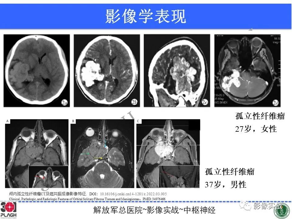 【病例】鞍区孤立性纤维瘤1例CT及MR影像-28