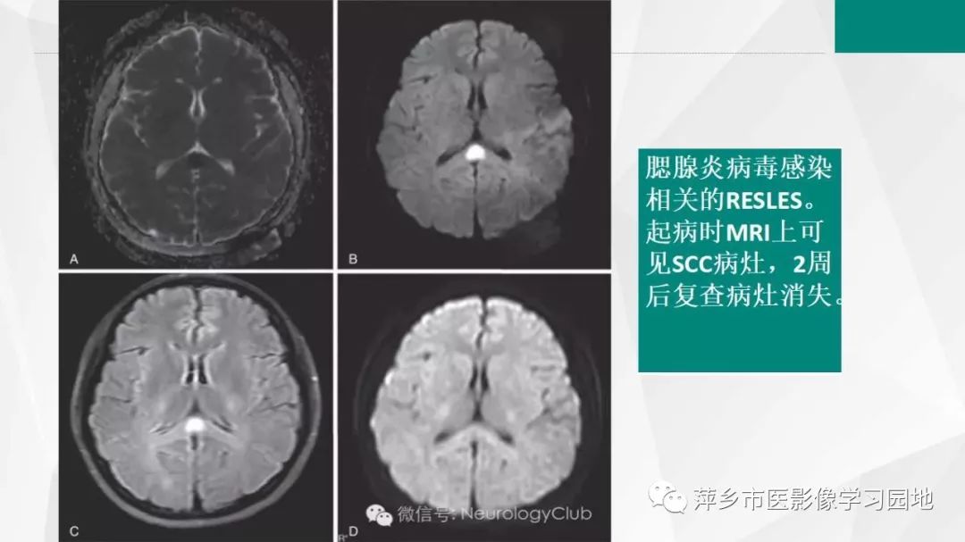 【PPT】可逆性胼胝体压部病变综合征-20