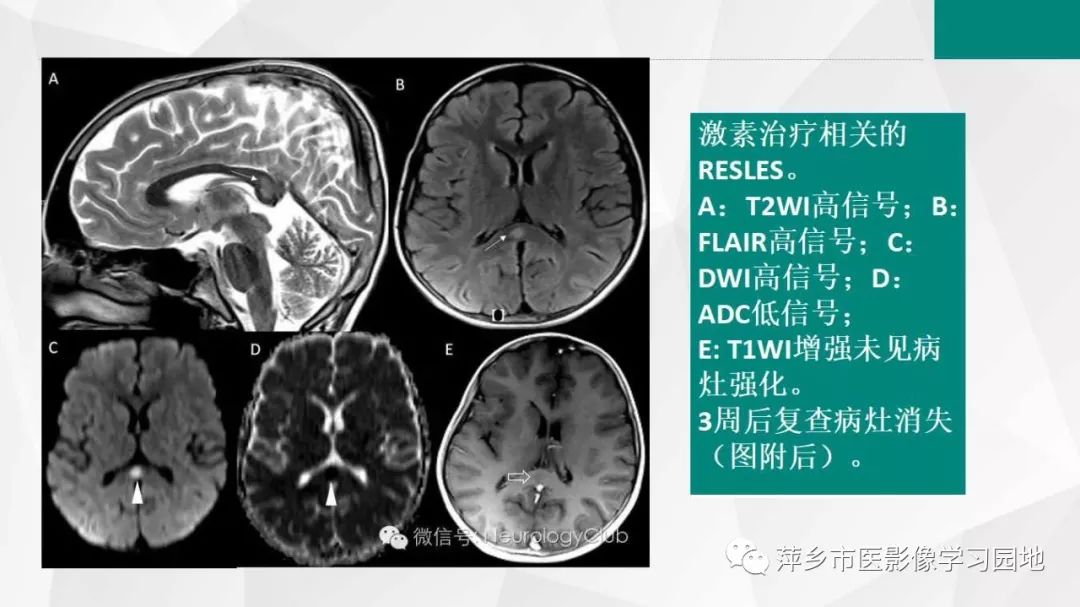 【PPT】可逆性胼胝体压部病变综合征-21