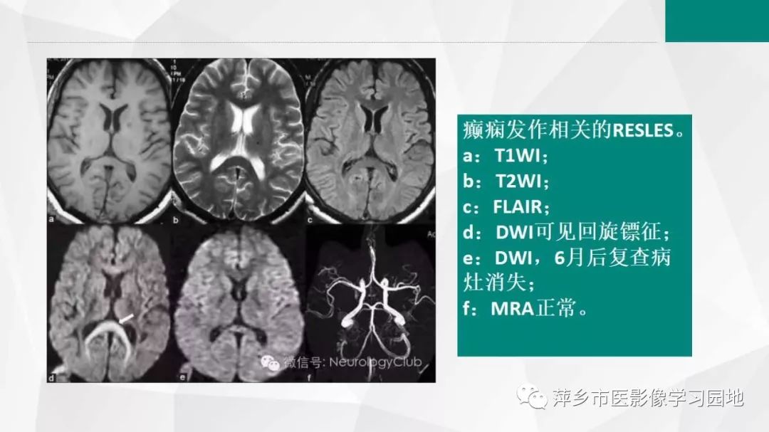 【PPT】可逆性胼胝体压部病变综合征-23