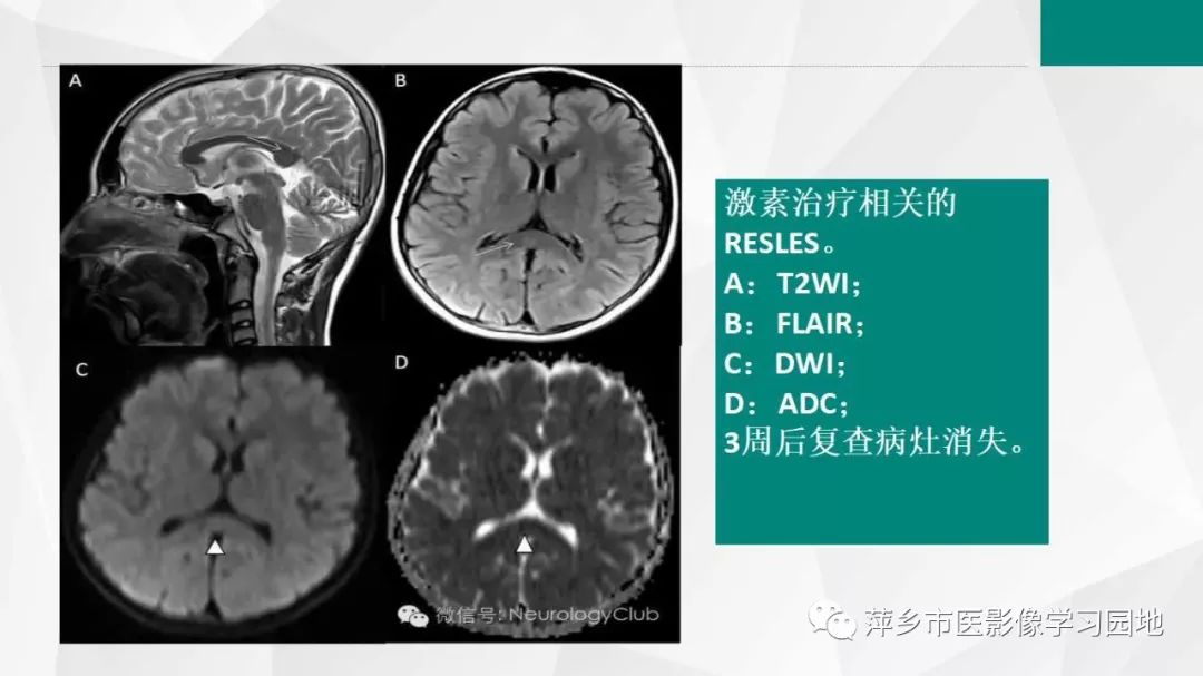 【PPT】可逆性胼胝体压部病变综合征-22