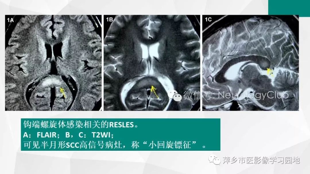 【PPT】可逆性胼胝体压部病变综合征-24