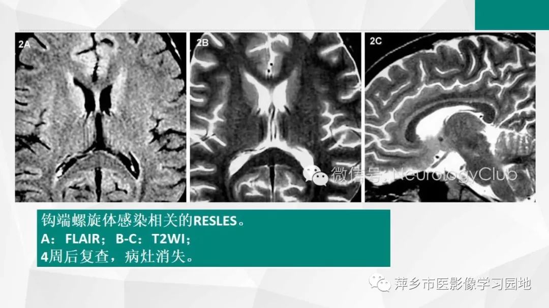 【PPT】可逆性胼胝体压部病变综合征-25