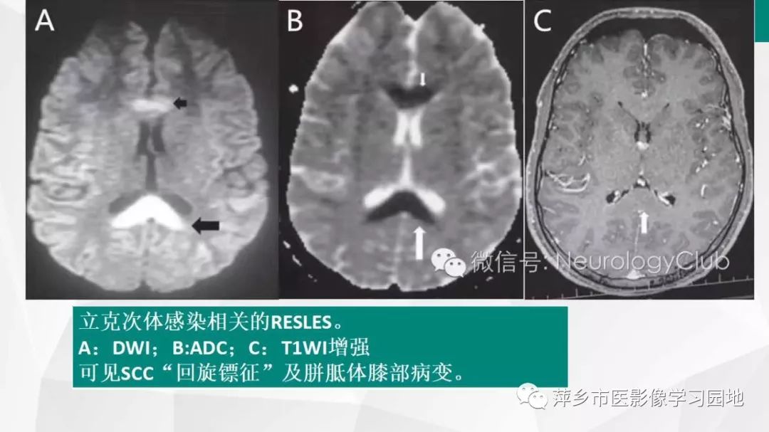 【PPT】可逆性胼胝体压部病变综合征-26