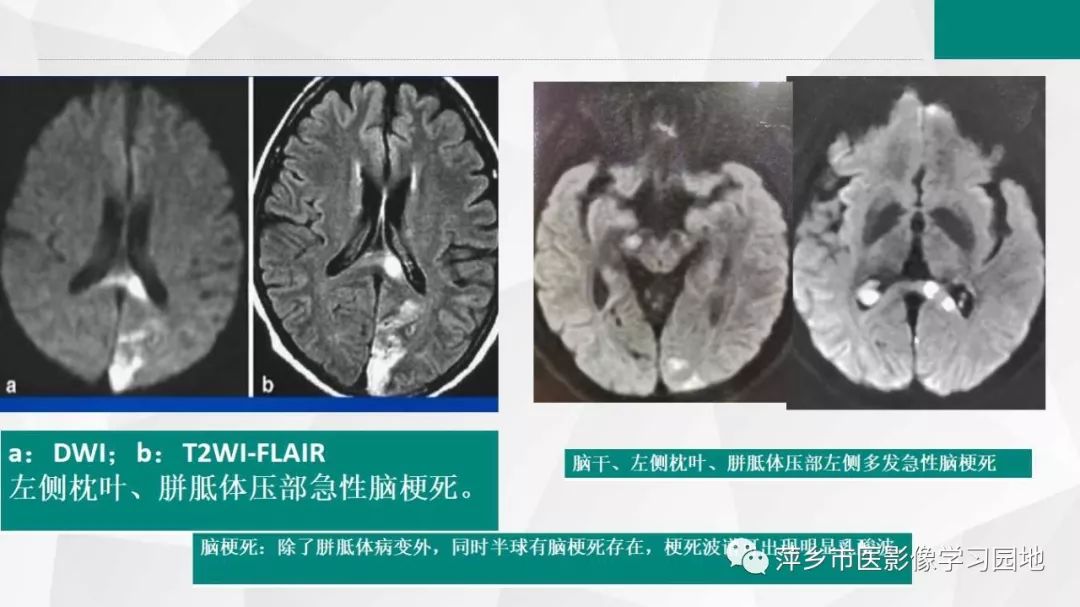 【PPT】可逆性胼胝体压部病变综合征-27