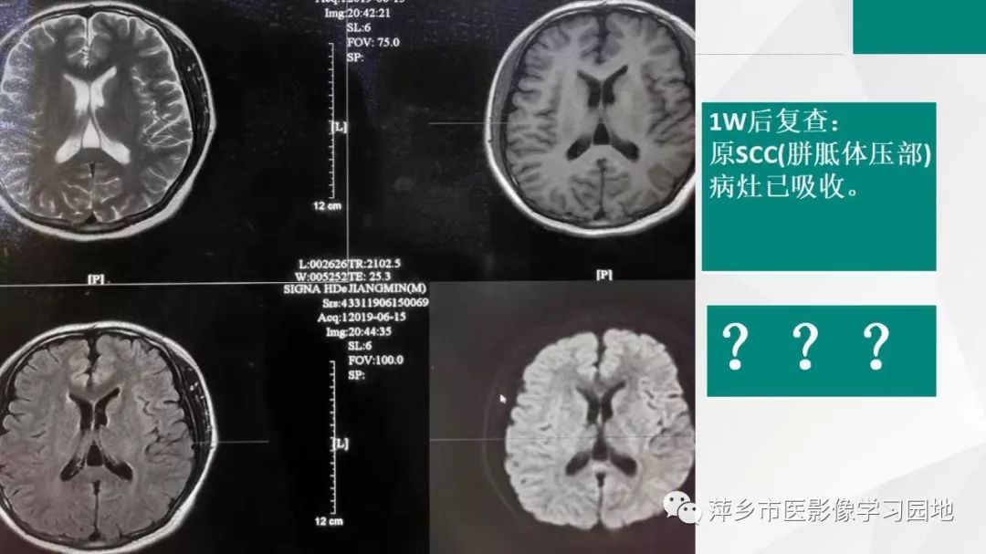 【PPT】可逆性胼胝体压部病变综合征-29