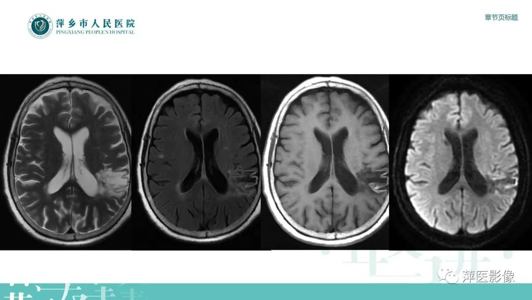 【PPT】脑皮质层状坏死的影像诊断-5