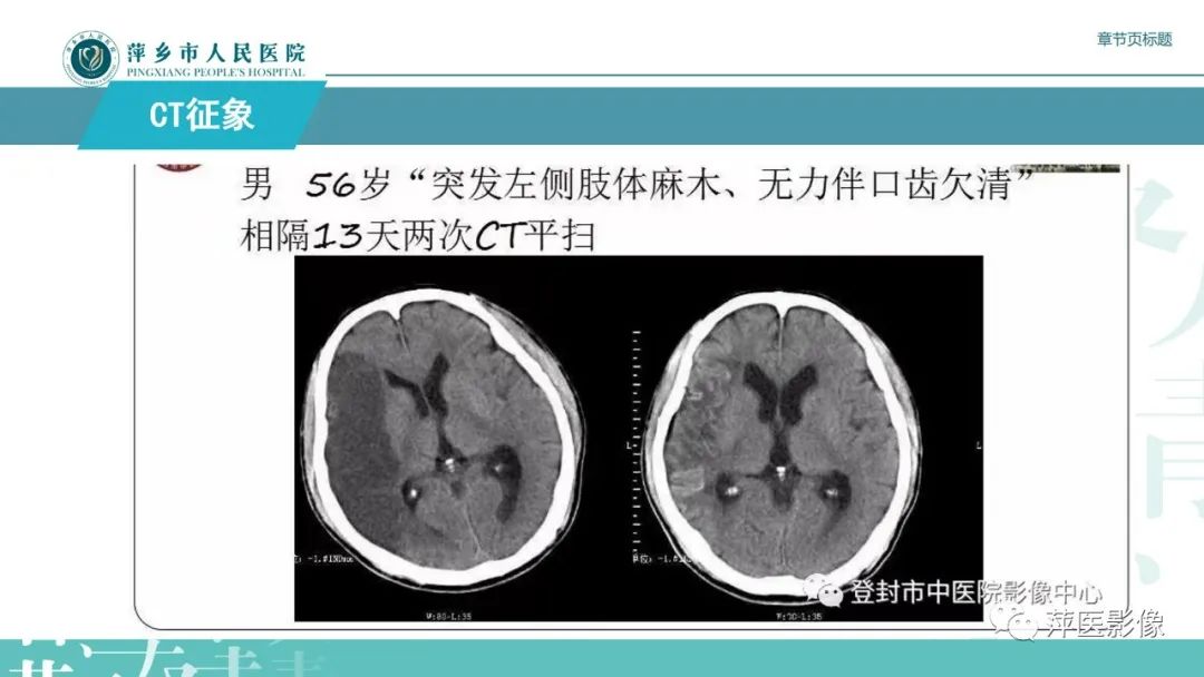【PPT】脑皮质层状坏死的影像诊断-18